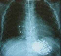 Auf dem Röntgenbild erkennt man den Herzschrittmacher und die zum Herzen führenden Elektroden